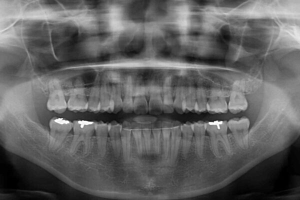 前歯のデコボコをインビザラインでスッキリと 治療後画像