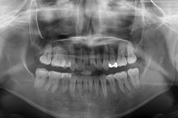 前歯の歯並びを治したい　ワイヤー装置での抜歯矯正 治療後画像