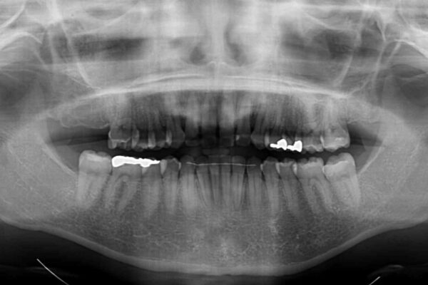 【モニター】前歯のデコボコをインビザラインできれいに整える 治療後画像