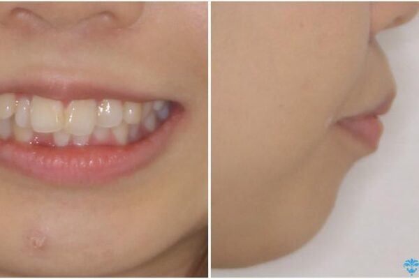 口元の突出感を改善　2年弱での抜歯矯正 治療前画像