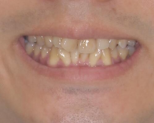上顎の狭い歯列をインビザラインで拡大 治療前画像
