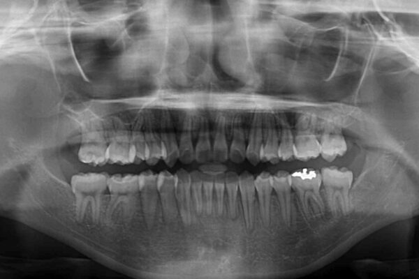 急速拡大装置で狭い歯列を骨格ごと改善　ワイヤー装置による矯正治療 治療後画像