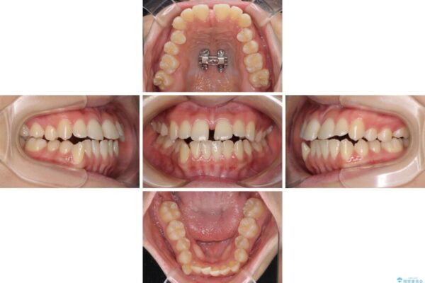 上顎骨拡大を用いたインビザラインによる非抜歯矯正 治療途中画像