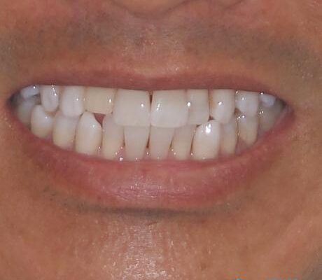 治療途中の前歯を治したい　インビザライン矯正とオールセラミッククラウン 治療前画像