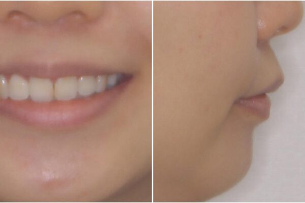 口元の突出感を改善　2年弱での抜歯矯正 治療後画像