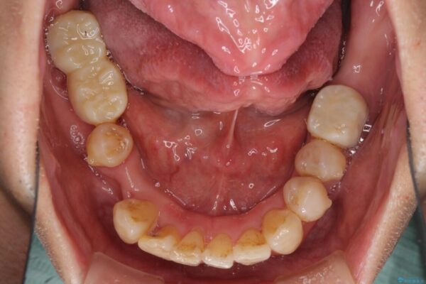 歯並びや奥歯の痛み　色々と治したい　総合歯科診療 治療途中画像