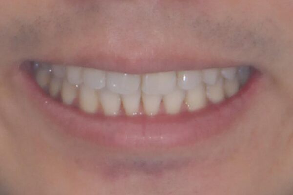 上顎の狭い歯列をインビザラインで拡大 治療後画像
