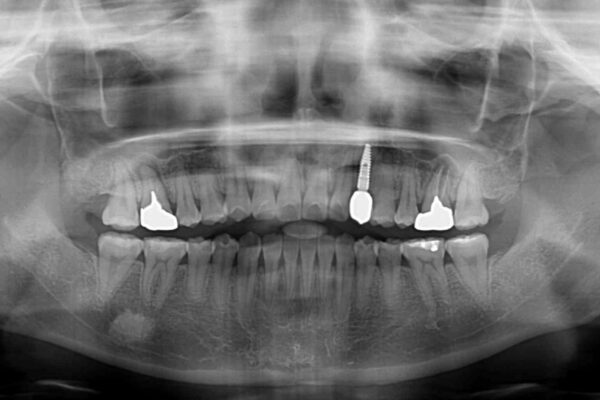 受け口で開咬を急速拡大装置とインビザラインで改善　欠損部分はインプラントにて補綴治療 治療後画像