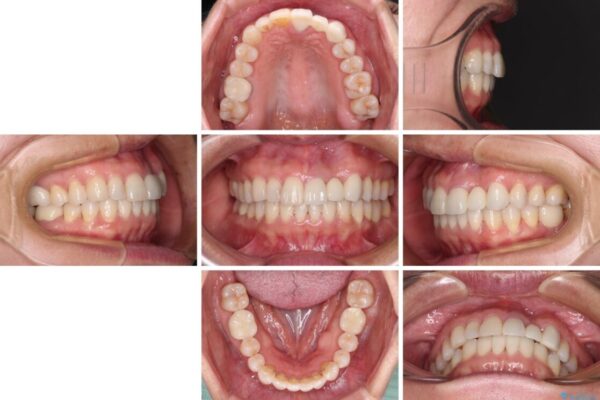 口元の突出感を治したい　治療中の歯も治したい 治療後画像