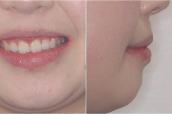 ふっくらとした口元を改善したい　目立たないワイヤー装置による抜歯矯正 治療後画像