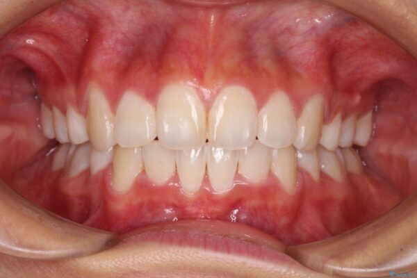 口元の突出感を改善　2年弱での抜歯矯正 治療後画像