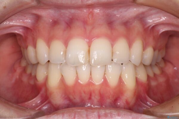【モニター】前歯のデコボコをインビザラインできれいに整える 治療後画像
