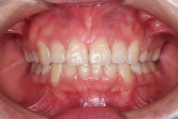 ふっくらとした口元を改善したい　目立たないワイヤー装置による抜歯矯正 治療後画像