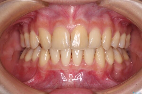 出っ歯を治したい　ワイヤー装置による抜歯矯正 治療後画像