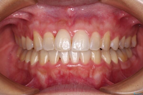 前歯のデコボコをインビザラインでスッキリと仕上げる 治療後画像