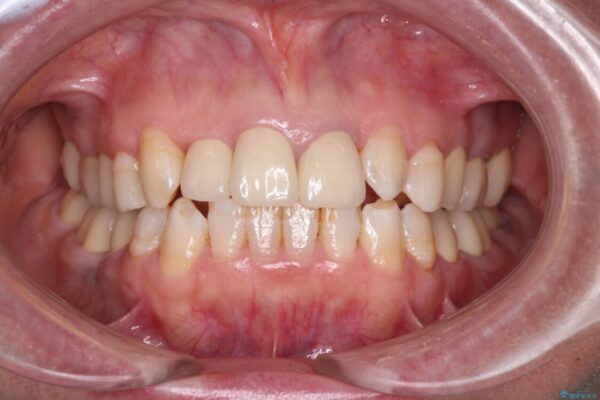 奥歯の銀歯と歯並びを改善　歯周外科治療と矯正治療を行った総合歯科診療 アフター