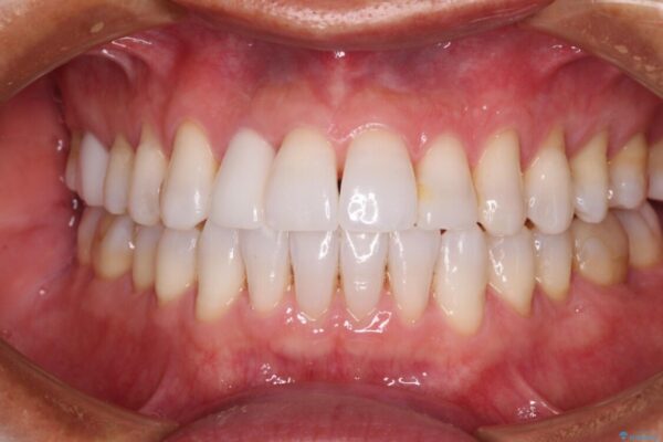 治療途中の前歯を治したい　インビザライン矯正とオールセラミッククラウン アフター