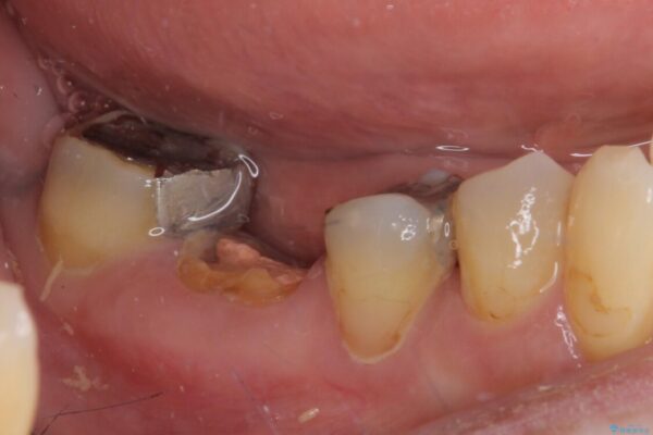 インプラントしかないと言われた　奥歯のオールセラミックブリッジ 治療前画像