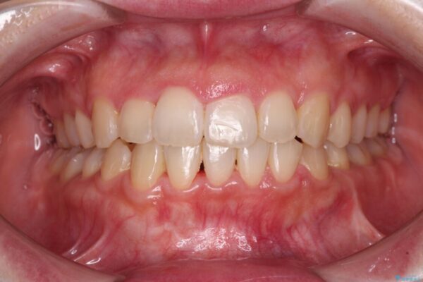 変則的な抜歯矯正　八重歯を抜いてしまった人のワイヤー矯正 アフター