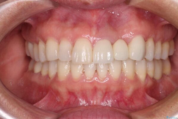 口元の突出感を治したい　治療中の歯も治したい アフター
