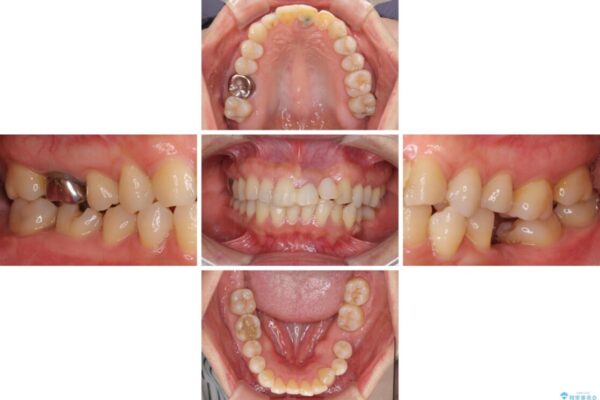 口元の突出感を治したい　治療中の歯も治したい 治療前画像