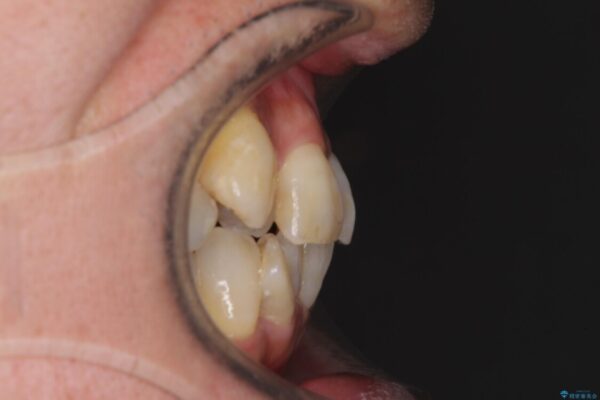 歯並びや奥歯の痛み　色々と治したい　総合歯科診療 治療前画像