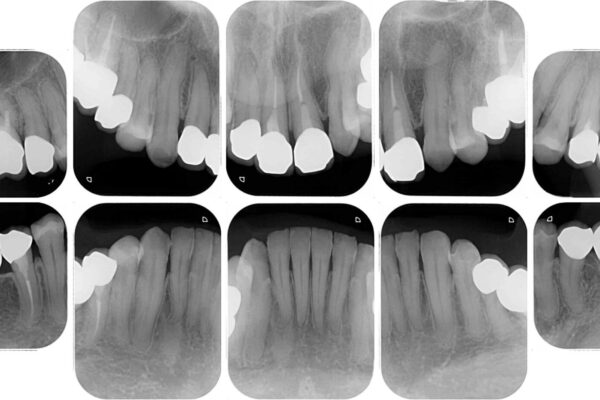 奥歯の銀歯と歯並びを改善　歯周外科治療と矯正治療を行った総合歯科診療 治療後画像