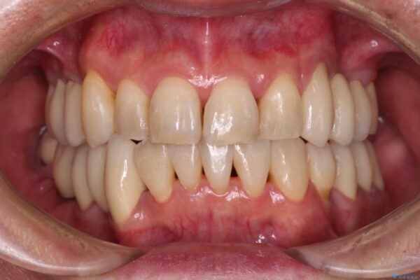 歯並びや奥歯の痛み　色々と治したい　総合歯科診療 アフター