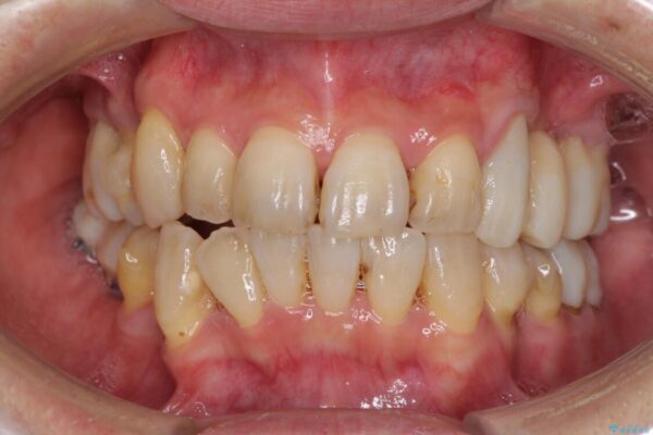 歯並びや奥歯の痛み　色々と治したい　総合歯科診療 治療途中画像