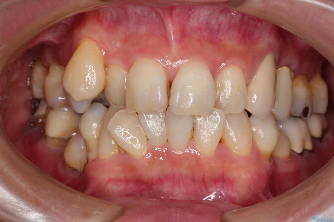 歯並びや奥歯の痛み　色々と治したい　総合歯科診療 治療前