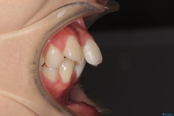 口元の突出感を改善　2年弱での抜歯矯正 ビフォー