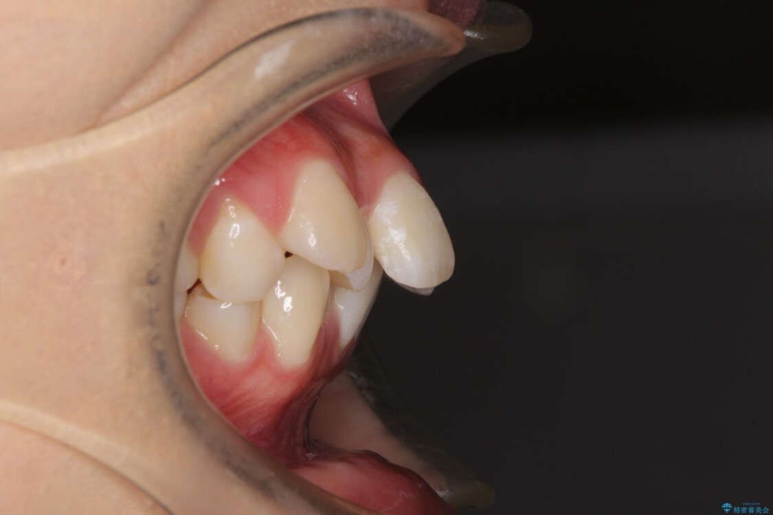 口元の突出感を改善　2年弱での抜歯矯正 治療前