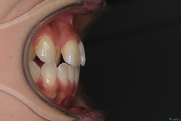 【モニター】幅の狭い上顎歯列　骨幅を拡大する矯正治療 治療前画像