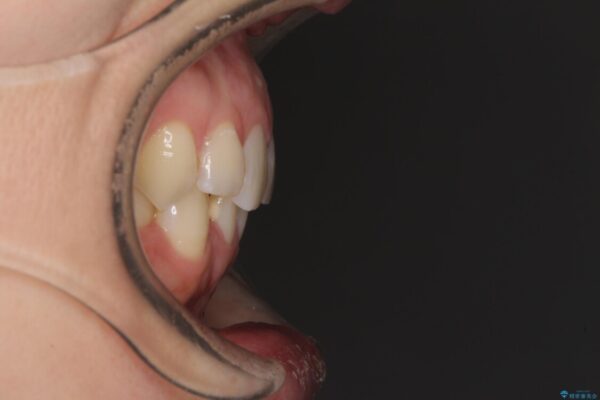 【モニター】前歯のデコボコと奥歯の虫歯　インビザライン治療と奥歯のセラミック治療 治療前画像