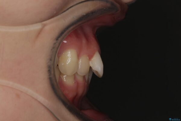 【モニター】犬歯のクロスバイトを目立たないワイヤー装置で 治療前画像