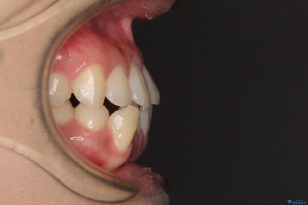 上顎骨拡大を用いたインビザラインによる非抜歯矯正 治療前画像