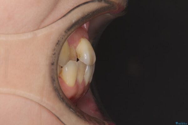 前歯のクロスバイトを治したい　インビザラインによる矯正治療 治療前画像