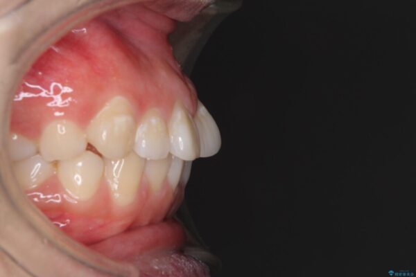 ふっくらとした口元を改善したい　目立たないワイヤー装置による抜歯矯正 治療前画像