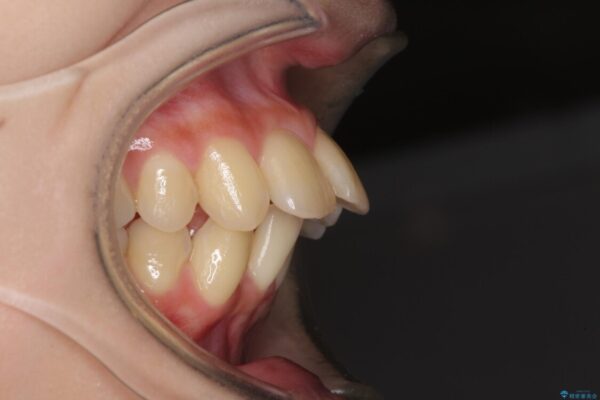 出っ歯を治したい　ワイヤー装置による抜歯矯正 ビフォー