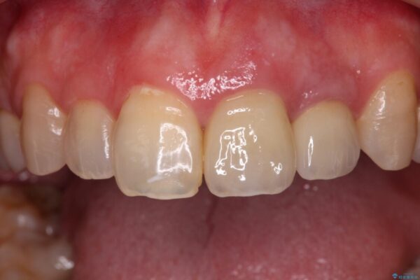 横から見た時の歯の色が違いすぎる　前歯のオールセラミッククラウン 治療後画像