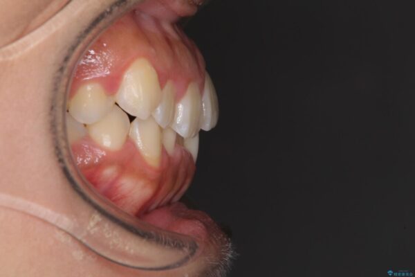 前歯のデコボコをインビザラインでスッキリと 治療前画像