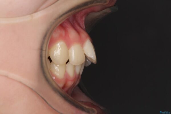飛び出した前歯と黄ばんだ歯　ホワイトニングしながらマウスピース矯正 治療前画像