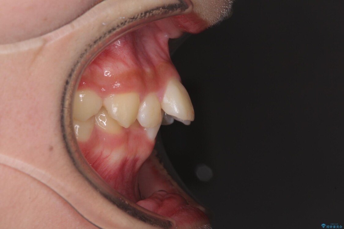 下の前歯が隠れてしまうほど深い咬み合わせ　高校生のインビザライン矯正治療 治療前