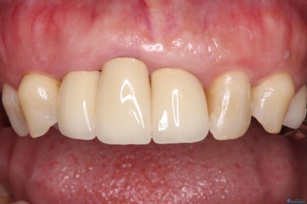歯茎の縁に見える変色を隠したい　前歯のオールセラミッククラウン 治療後画像
