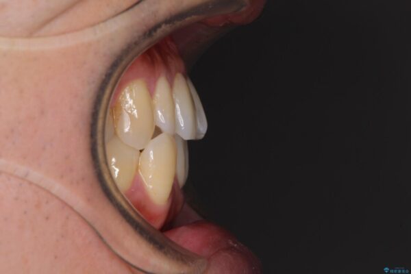 受け口傾向の咬み合わせ　前歯のデコボコをワイヤー矯正で素早く改善 治療前画像