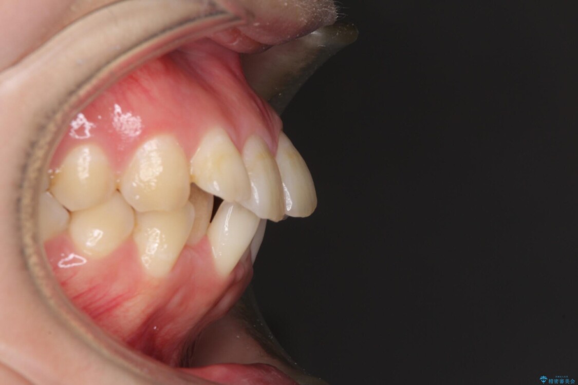 前歯の出っ歯と口の閉じにくさを抜歯矯正で改善　目立たないワイヤー矯正 治療前