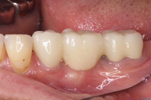 抜かずに保存した奥歯が痛くて臭う　セラミックブリッジによる欠損補綴治療 治療後画像