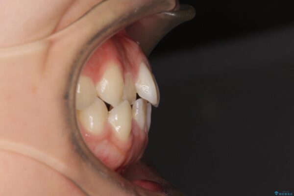 気になる八重歯を治したい　目立たないワイヤーでの抜歯矯正 治療前画像