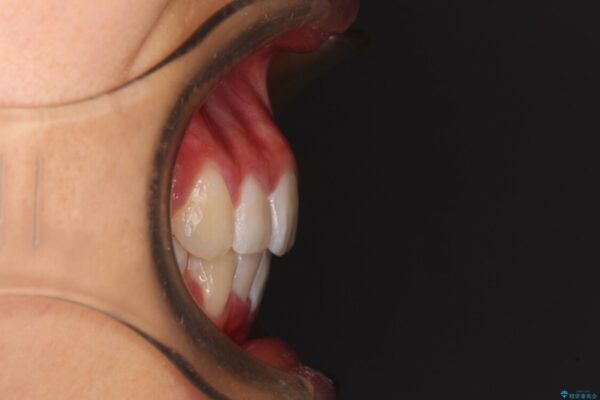 口元の突出感を改善　2年弱での抜歯矯正 アフター