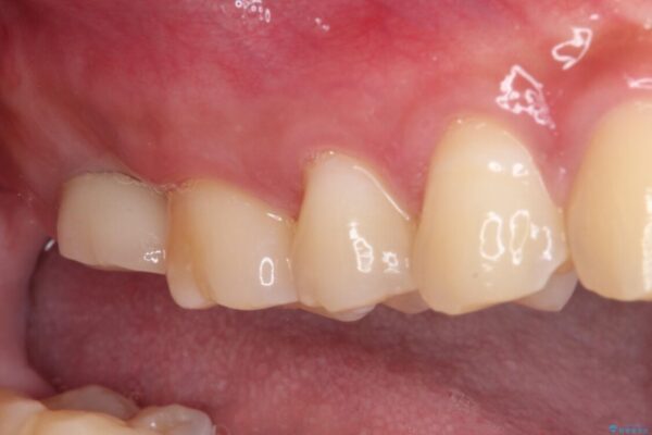 歯に穴を開けられてしまった　インプラントによる奥歯の補綴治療 治療後画像